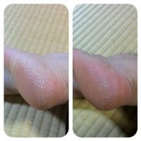 お見苦しい踵でｽﾐﾏｾﾝ。　SCHOLL VELVET SMOOTH 電動角質リムーバー 